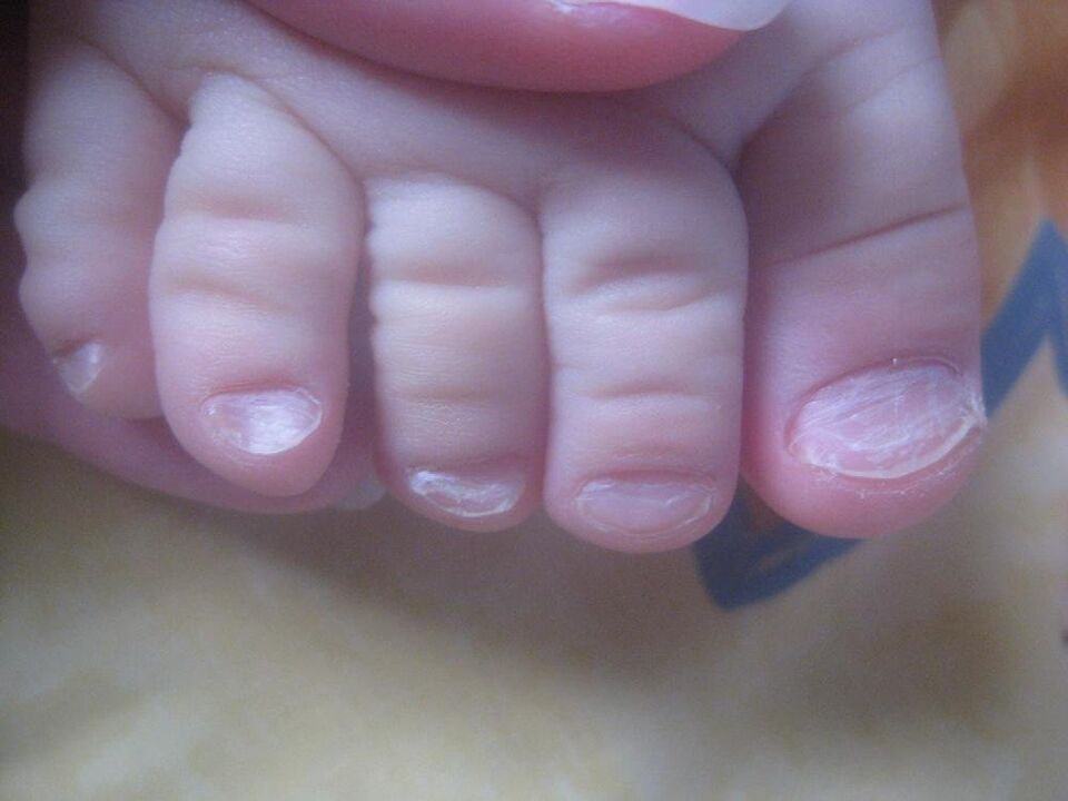 grzyb na paznokciach u dzieci