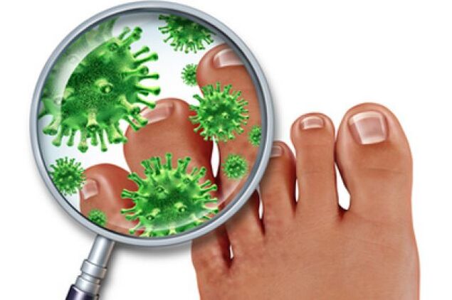 infekcja grzybicza na paznokciach stóp