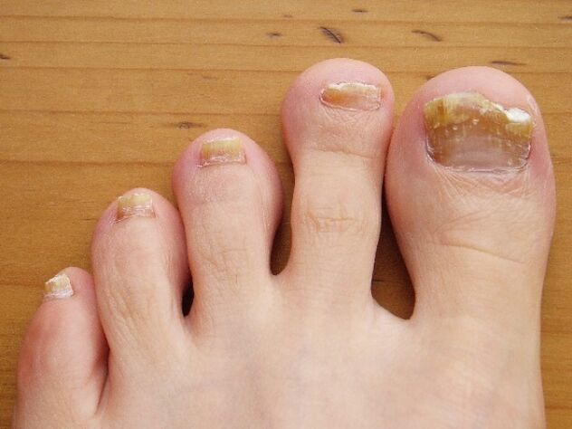 uszkodzenie płytki paznokcia grzybem