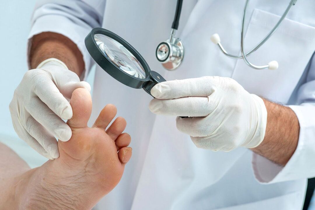 lekarz bada stopy z grzybicą
