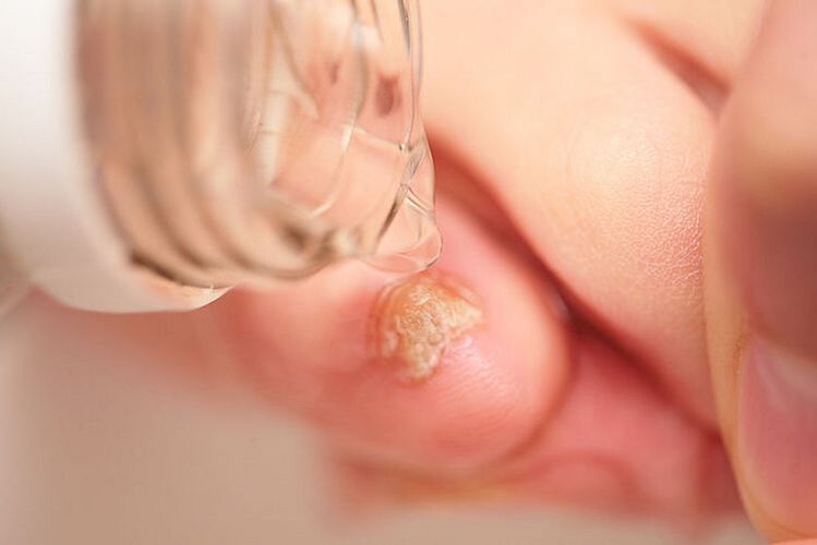 leczenie grzybicy paznokci octem
