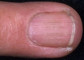 oznaki grzybicy paznokci
