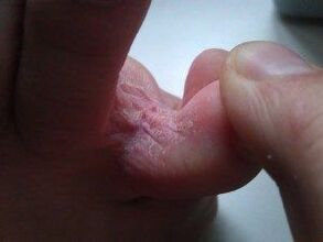 zmiany skórne między palcami stóp z grzybicą