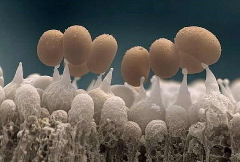 grzybica paznokci pod mikroskopem