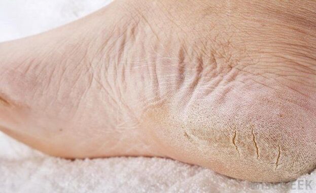 suche stopy są oznaką grzybicy