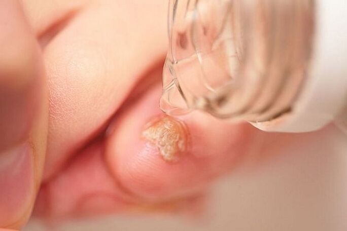leczenie grzybów paznokci u stóp octem