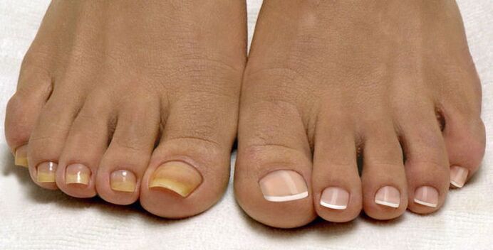 zdrowe paznokcie u nóg i paznokci dotkniętych grzybem