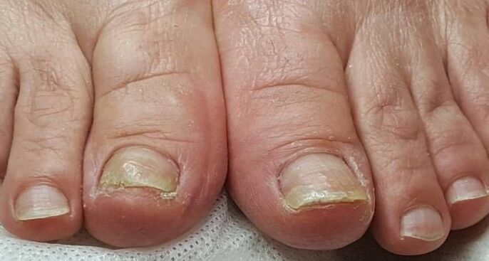uszkodzenie paznokci z grzybem na stopach