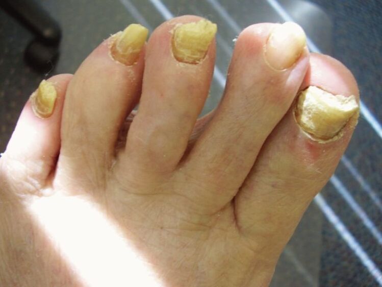 zaniedbany grzyb paznokci