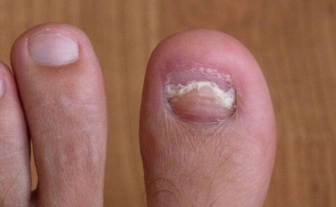 uszkodzenie paznokcia dużego palca przez grzyb