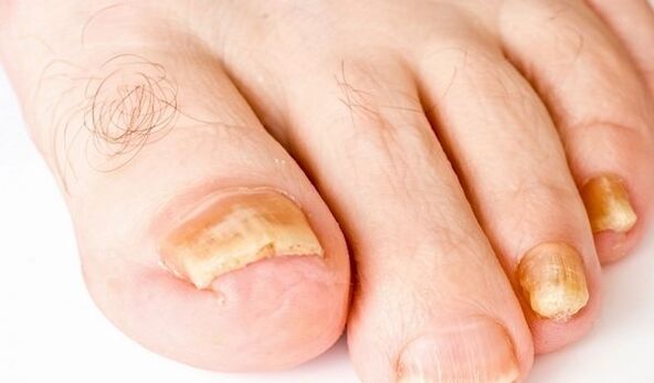 zdjęcie objawów grzybicy paznokci stóp
