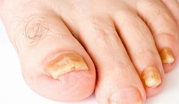żółte paznokcie na infekcje grzybicze