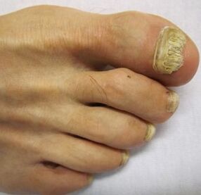 zaawansowane stadium grzybicy paznokci stóp